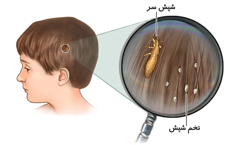 علائم-شپش-سر