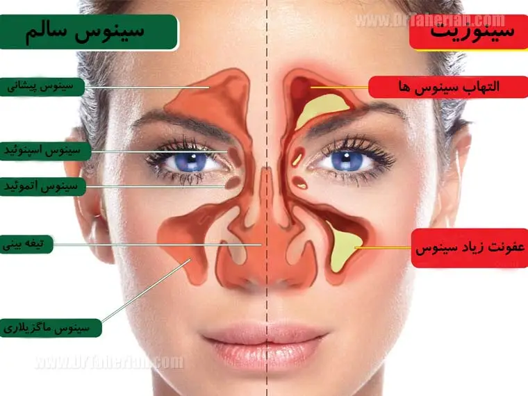 نشانه های سینوزیت شستشوی آن به وسیله ی سینوس واش