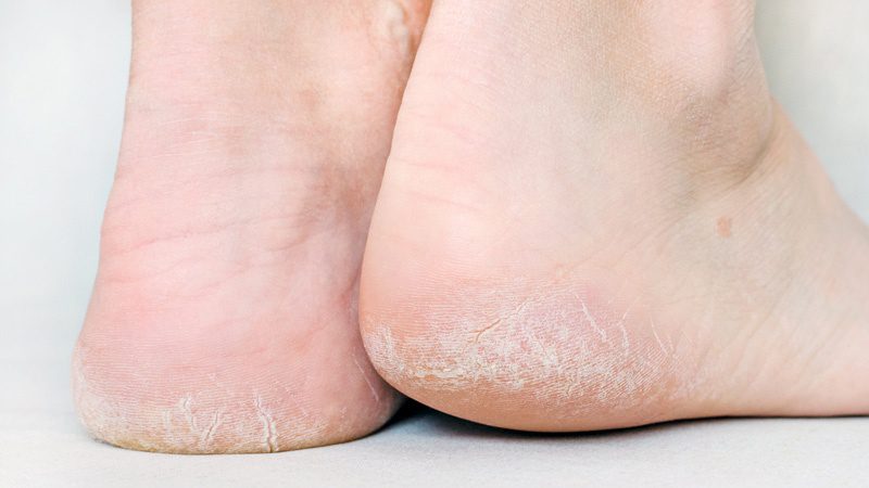 علت ترک پا و سریع‌ترین راه‌های درمان آن